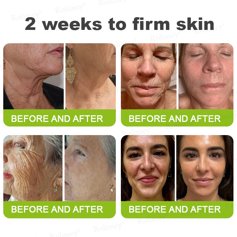 🔥Made and shipped from the UK🧑‍⚕️💫Rolimey® Botox & Vita-A Retinol Shot Wrinkle-Lift Tightening cream - Last Day Promotion 70% OFF