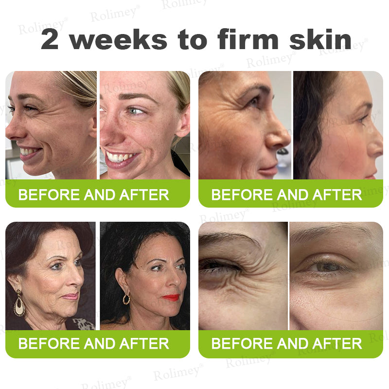 🔥Made and shipped from the UK🧑‍⚕️💫Rolimey® Botox & Vita-A Retinol Shot Wrinkle-Lift Tightening cream - Last Day Promotion 70% OFF