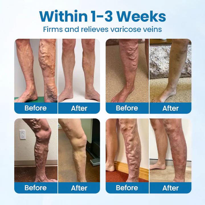 🔥Ourlyard® VeinGuard Herbal Spray-✅ Clinically proven to eliminate varicose veins in just 7 days! (🔥Limited Time 80% OFF🔥)