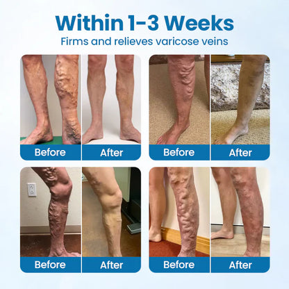 🔥Ourlyard® VeinGuard Herbal Spray-✅ Clinically proven to eliminate varicose veins in just 7 days! (🔥Limited Time 80% OFF🔥)