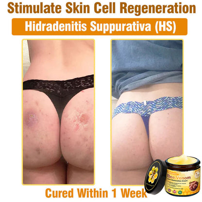 🔥Pheromex® Bee Venom Skin Restoration Cream — 🔥Limited Time 80% OFF🔥