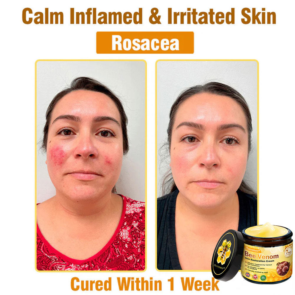 🔥Pheromex® Bee Venom Skin Restoration Cream — 🔥Limited Time 80% OFF🔥
