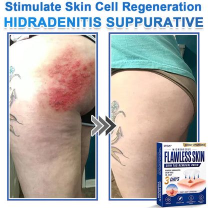 💎GFOUK® 2026 Newly Upgraded 2-in-1 Microneedle Hydrocolloid Patches | Removes Raised Moles, Acne, Flat Warts, and Skin Tags | Improves Wrinkles, Scars, and Blemishes | Invisible Acne Patches for Face & Body