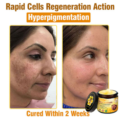 🔥Pheromex® Bee Venom Skin Restoration Cream — 🔥Limited Time 80% OFF🔥