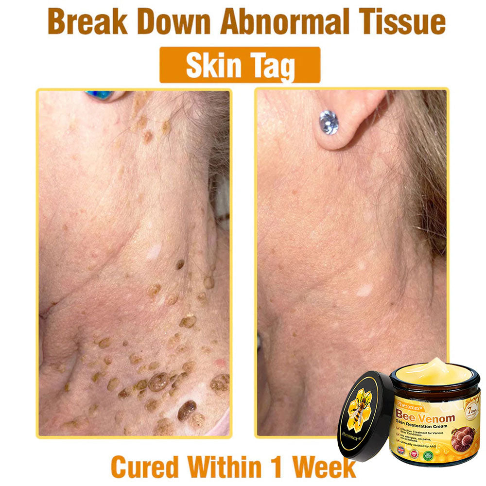 🔥Pheromex® Bee Venom Skin Restoration Cream — 🔥Limited Time 80% OFF🔥