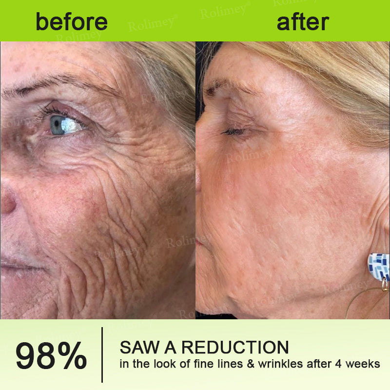 🔥Made and shipped from the UK🧑‍⚕️💫Rolimey® Botox & Vita-A Retinol Shot Wrinkle-Lift Tightening cream - Last Day Promotion 70% OFF