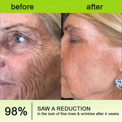 🔥Made and shipped from the UK🧑‍⚕️💫Rolimey® Botox & Vita-A Retinol Shot Wrinkle-Lift Tightening cream - Last Day Promotion 70% OFF