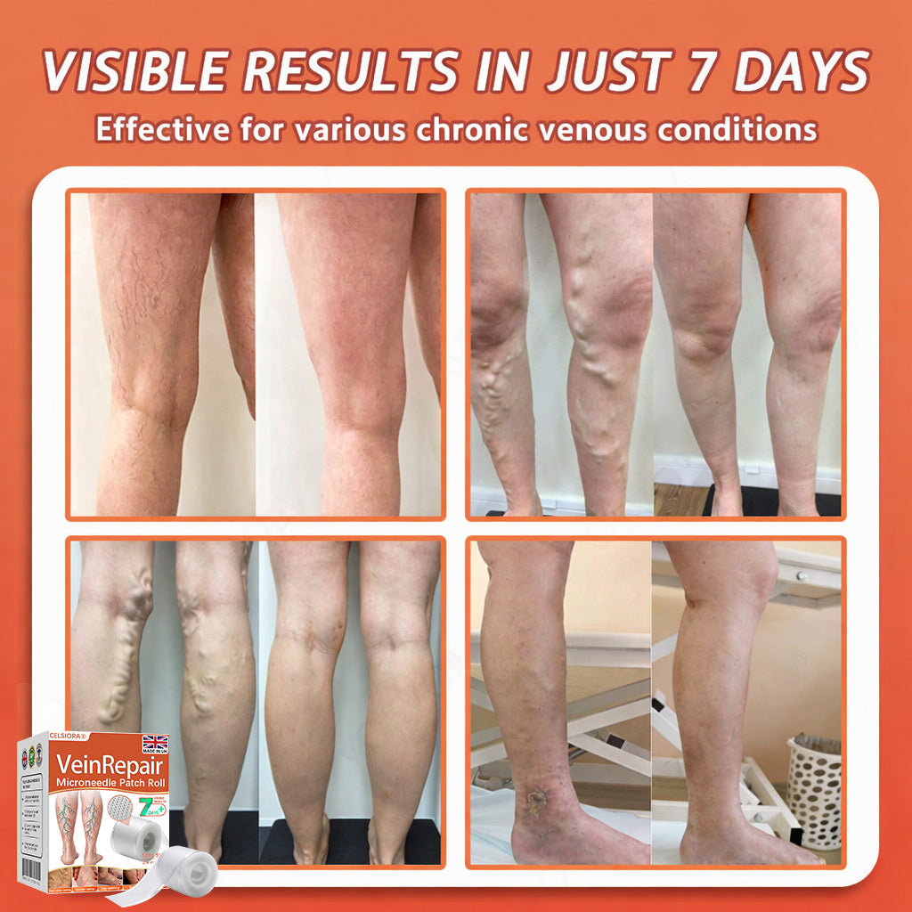 🧑‍⚕️🔥Celsiora® Vein Ease Microneedle Care Patch(For Spider Veins, Varicose Veins, Swelling & Leg Fatigue) - Last Day Promotion 50% OFF