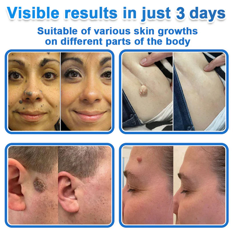 💎GFOUK® 2026 Newly Upgraded 2-in-1 Microneedle Hydrocolloid Patches | Removes Raised Moles, Acne, Flat Warts, and Skin Tags | Improves Wrinkles, Scars, and Blemishes | Invisible Acne Patches for Face & Body