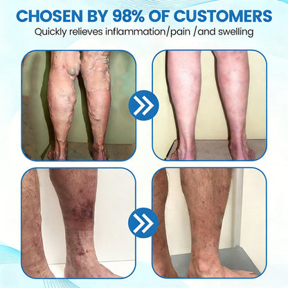 🇬🇧🔥GFOUK® VEINRX Healing Spray (Designed for Varicose veins, Spider veins, Deep vein Thrombosis, Chronic venous insufficiency, Venous ulcers, Thrombophlebitis and other venous issues)