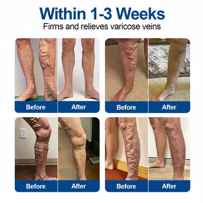 🇬🇧👨‍⚕️🔥GFOUK® VeinEase Microneedle Care Patch⚡Instant Relief, Long-Term Results