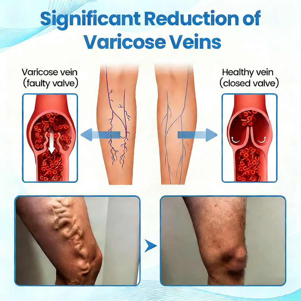 🇬🇧🔥GFOUK® VEINRX Healing Spray (Designed for Varicose veins, Spider veins, Deep vein Thrombosis, Chronic venous insufficiency, Venous ulcers, Thrombophlebitis and other venous issues)
