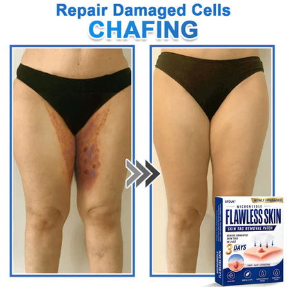 💎GFOUK® 2026 Newly Upgraded 2-in-1 Microneedle Hydrocolloid Patches | Removes Raised Moles, Acne, Flat Warts, and Skin Tags | Improves Wrinkles, Scars, and Blemishes | Invisible Acne Patches for Face & Body