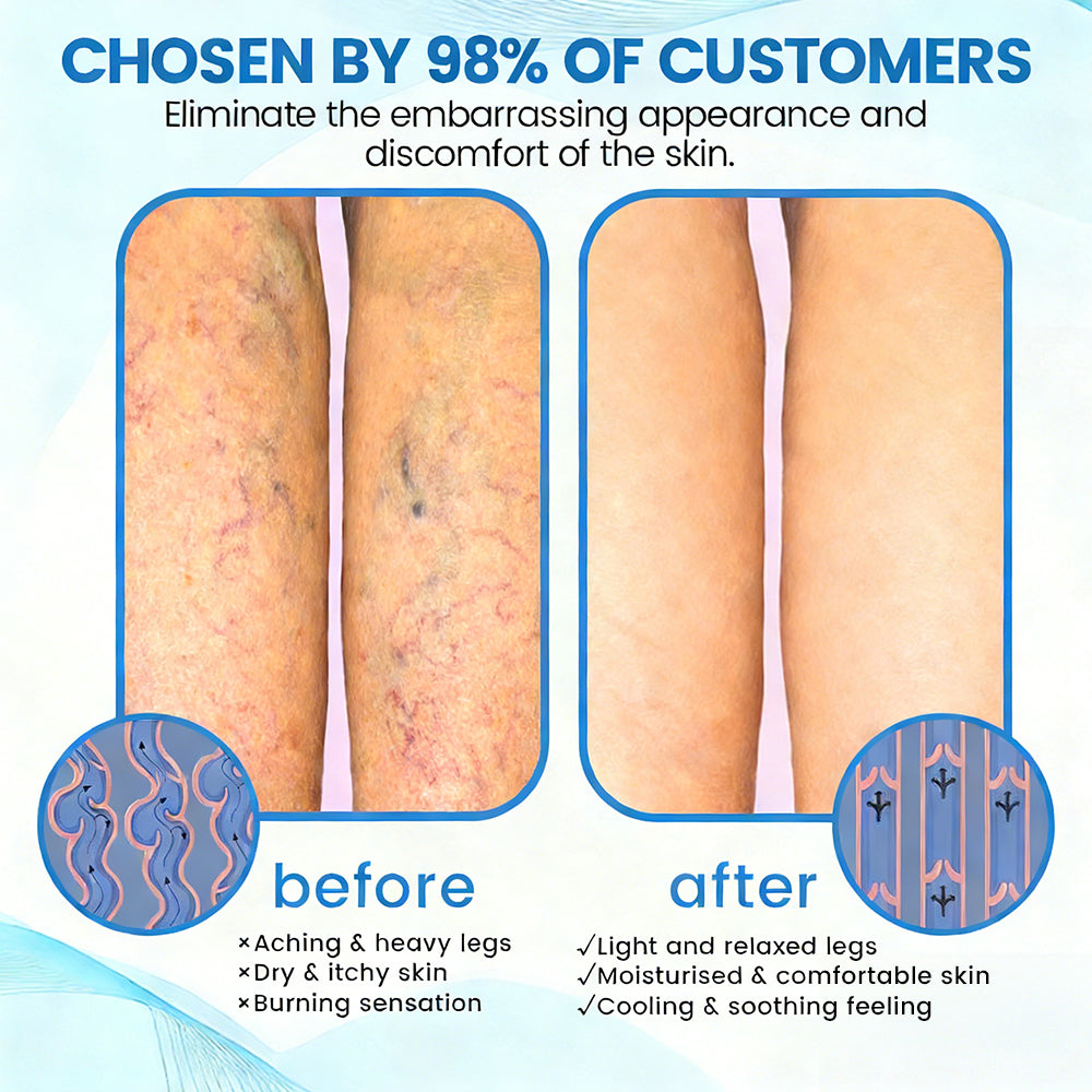 🇬🇧🔥GFOUK® VEINRX Healing Spray (Designed for Varicose veins, Spider veins, Deep vein Thrombosis, Chronic venous insufficiency, Venous ulcers, Thrombophlebitis and other venous issues)
