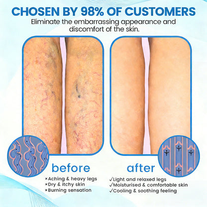 🇬🇧🔥GFOUK® VEINRX Healing Spray (Designed for Varicose veins, Spider veins, Deep vein Thrombosis, Chronic venous insufficiency, Venous ulcers, Thrombophlebitis and other venous issues)