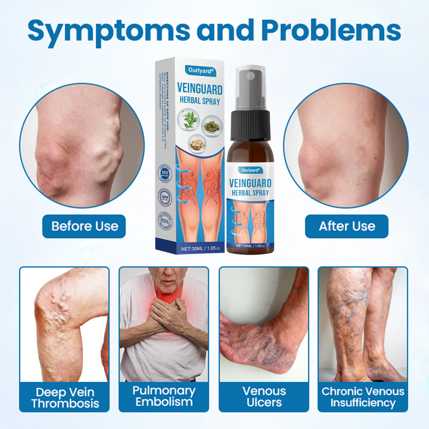 🔥Ourlyard® VeinGuard Herbal Spray-✅ Clinically proven to eliminate varicose veins in just 7 days! (🔥Limited Time 80% OFF🔥)
