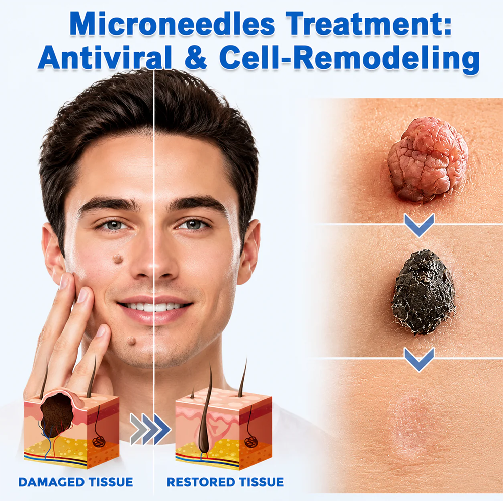 ✨GFOUK® 2-in-1 Microneedle & Hydrocolloid Patch🍀 | Removes raised moles, acne, flat warts, and skin tags | Invisible patches for face and body