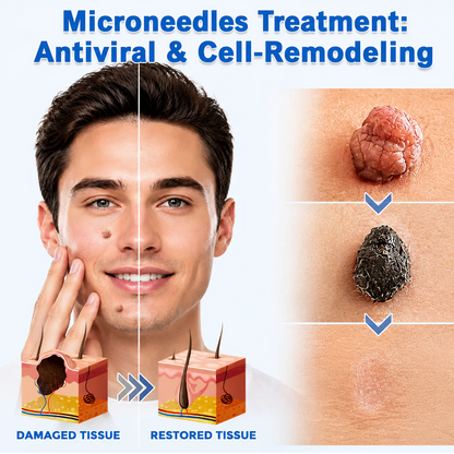✨GFOUK® 2-in-1 Microneedle & Hydrocolloid Patch🍀 | Removes raised moles, acne, flat warts, and skin tags | Invisible patches for face and body