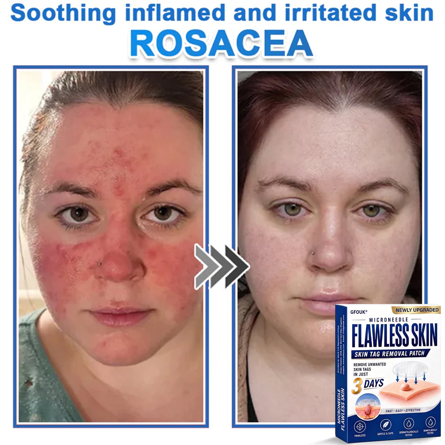 💎GFOUK® 2026 Newly Upgraded 2-in-1 Microneedle Hydrocolloid Patches | Removes Raised Moles, Acne, Flat Warts, and Skin Tags | Improves Wrinkles, Scars, and Blemishes | Invisible Acne Patches for Face & Body