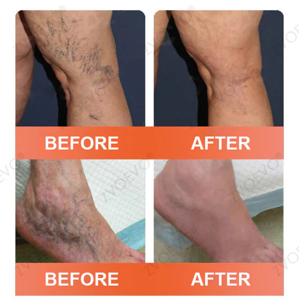 🧑‍⚕️🔥Celsiora® Vein Ease Microneedle Care Patch(For Spider Veins, Varicose Veins, Swelling & Leg Fatigue) - Last Day Promotion 50% OFF