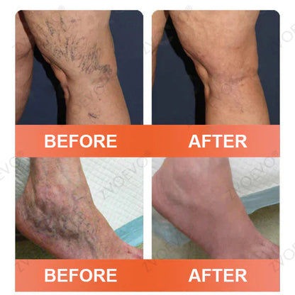 🧑‍⚕️🔥Celsiora® Vein Ease Microneedle Care Patch(For Spider Veins, Varicose Veins, Swelling & Leg Fatigue) - Last Day Promotion 50% OFF