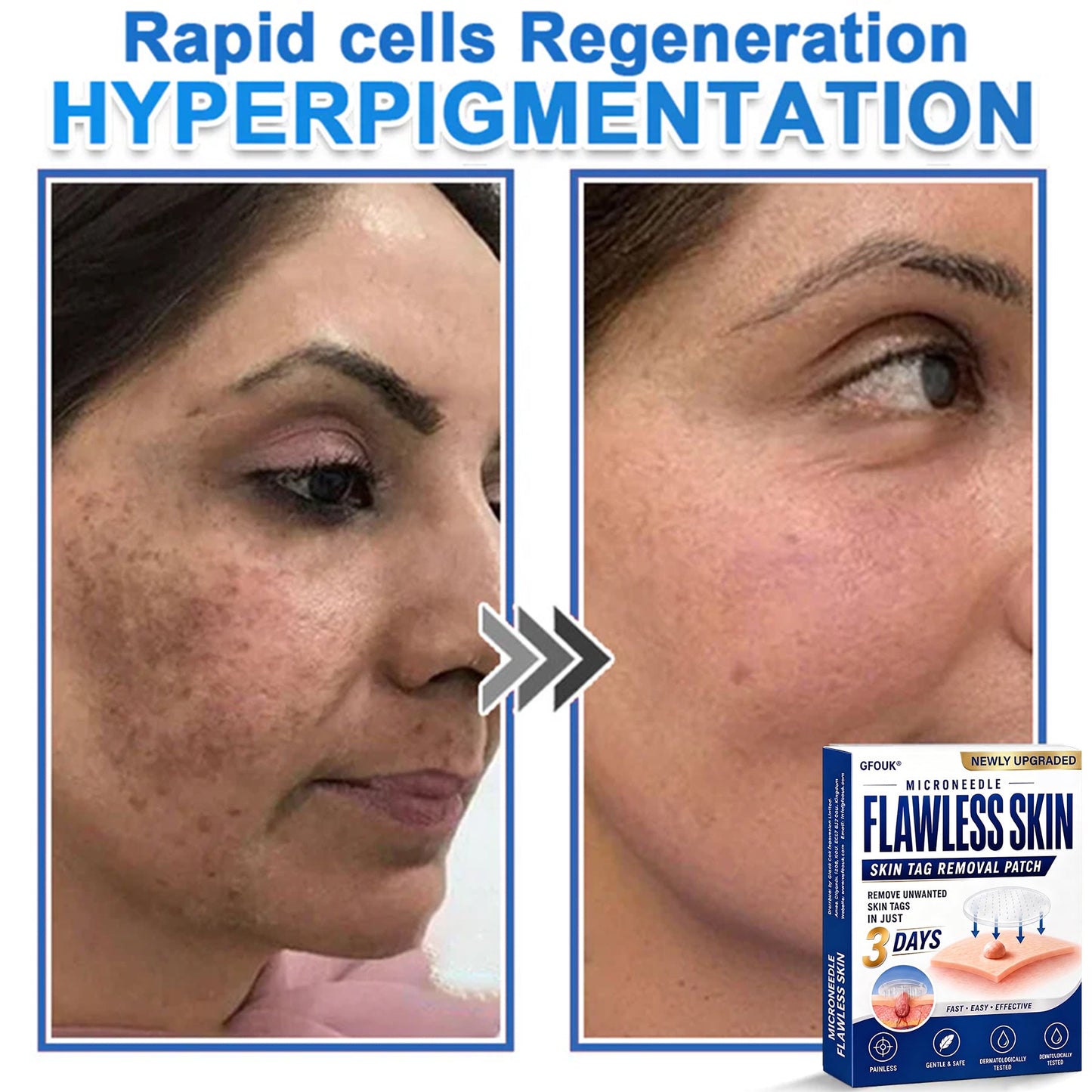 💎GFOUK® 2026 Newly Upgraded 2-in-1 Microneedle Hydrocolloid Patches | Removes Raised Moles, Acne, Flat Warts, and Skin Tags | Improves Wrinkles, Scars, and Blemishes | Invisible Acne Patches for Face & Body
