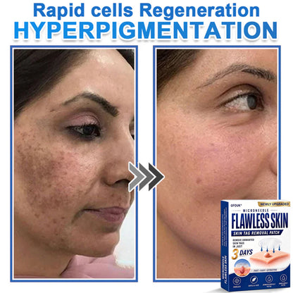 💎GFOUK® 2026 Newly Upgraded 2-in-1 Microneedle Hydrocolloid Patches | Removes Raised Moles, Acne, Flat Warts, and Skin Tags | Improves Wrinkles, Scars, and Blemishes | Invisible Acne Patches for Face & Body