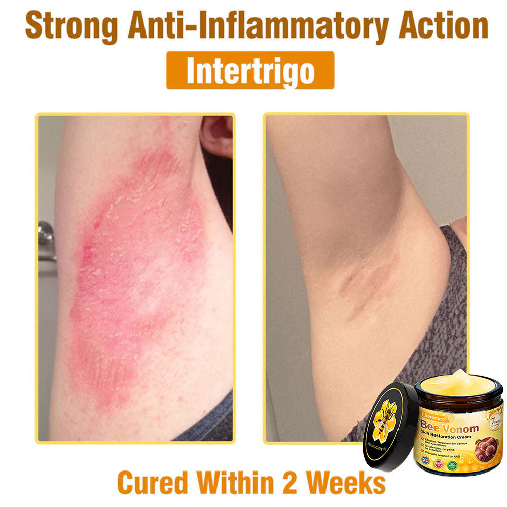 🔥Pheromex® Bee Venom Skin Restoration Cream — 🔥Limited Time 80% OFF🔥