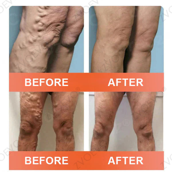 🧑‍⚕️🔥Celsiora® Vein Ease Microneedle Care Patch(For Spider Veins, Varicose Veins, Swelling & Leg Fatigue) - Last Day Promotion 50% OFF