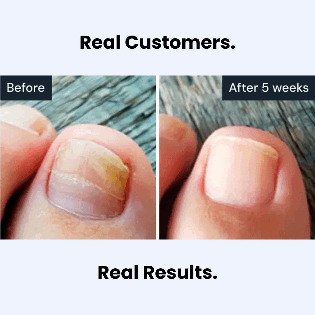 GFOUK™ Antifungal Pen