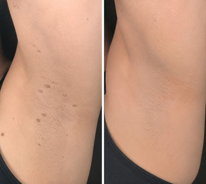 ✨GFOUK® 2-in-1 Microneedle & Hydrocolloid Patch🍀 | Removes raised moles, acne, flat warts, and skin tags | Invisible patches for face and body