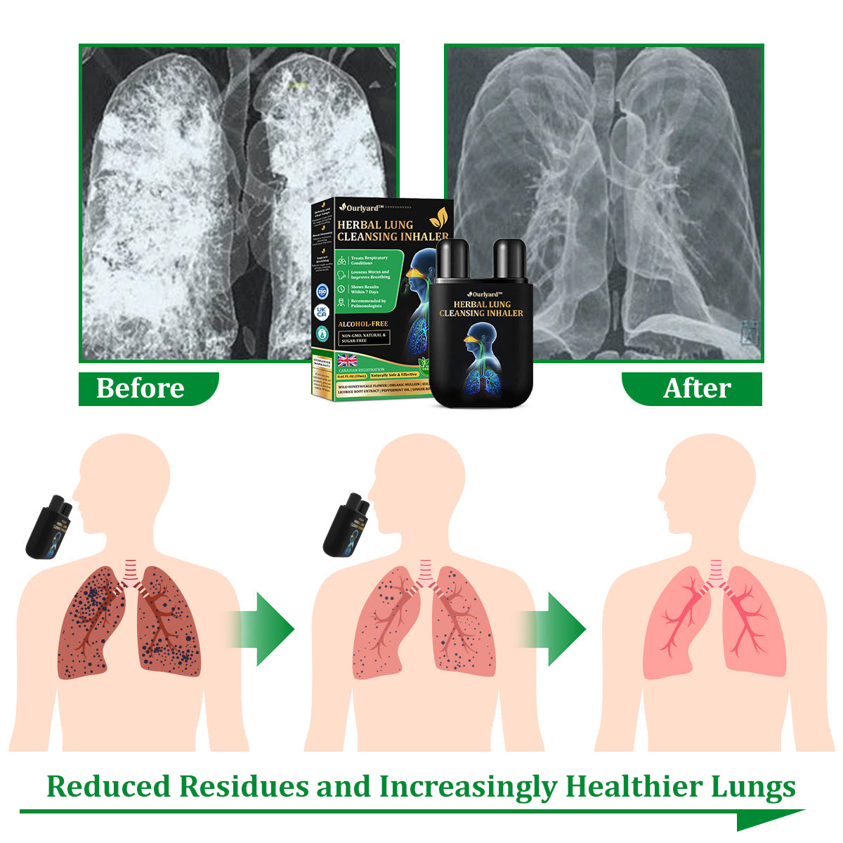 💯✅Official Store:Ourlyard™ Herbal Lung Cleansing Inhaler 🫁MHRA Approved(💝 Cough, wheezing, shortness of breath, sputum, stuffy nose, bronchitis, bronchitis, allergy symptoms, lung discomfort💝)